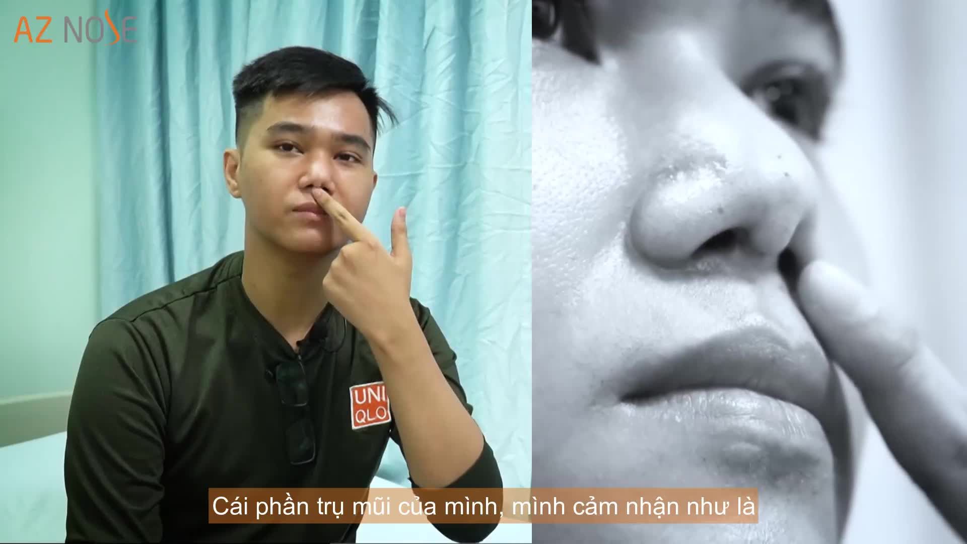 CHÀNG TRAI TRẢI QUA 11 LẦN PHẪU THUẬT ĐAU ĐỚN ĐẾN BIẾN DẠNG TRỤ MŨI