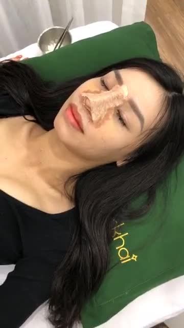 "Bác sĩ nâng mũi nhớ chỉnh xương bè giúp em, mũi em to quá"