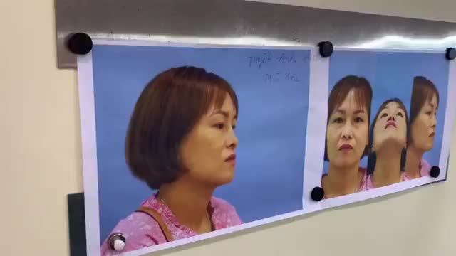 CA MŨI KHÓ, KHÁCH HÀNG TỪNG SỬA MŨI BỊ HỎNG, TRỤ MŨI LỆCH, 2 CÁNH MŨI LẠI KHÔNG ĐỀU, DẪN ĐẾN MẤT ĐI SỰ CÂN ĐỐI CỦA GƯƠNG MẶT.