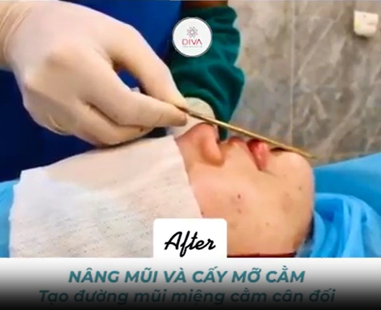 ĐƯỜNG E LINE - HAY ĐƯỜNG MŨI MIỆNG CẰM TRÊN GƯƠNG MẶT QUAN TRỌNG VÌ SAO?