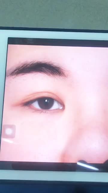 Khách hàng thực hiện cắt mí Elite Eyes trực tiếp bs Hồng Vân - Thẩm mỹ DrD.