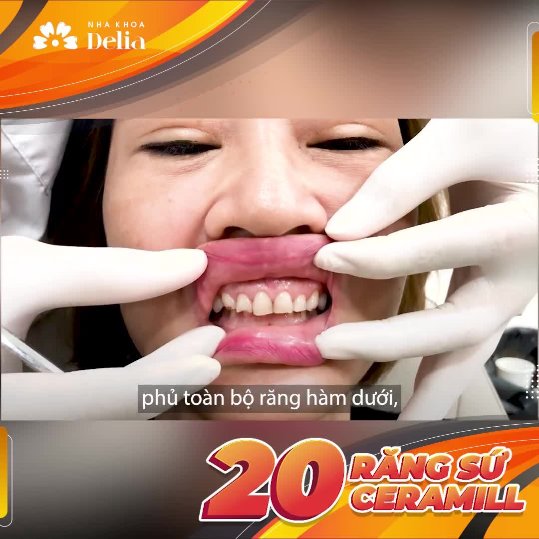 Nhiễm tetra - Khớp cắn sâu - Mòn mặt nhai - ĐÂU LÀ GIẢI PHÁP?