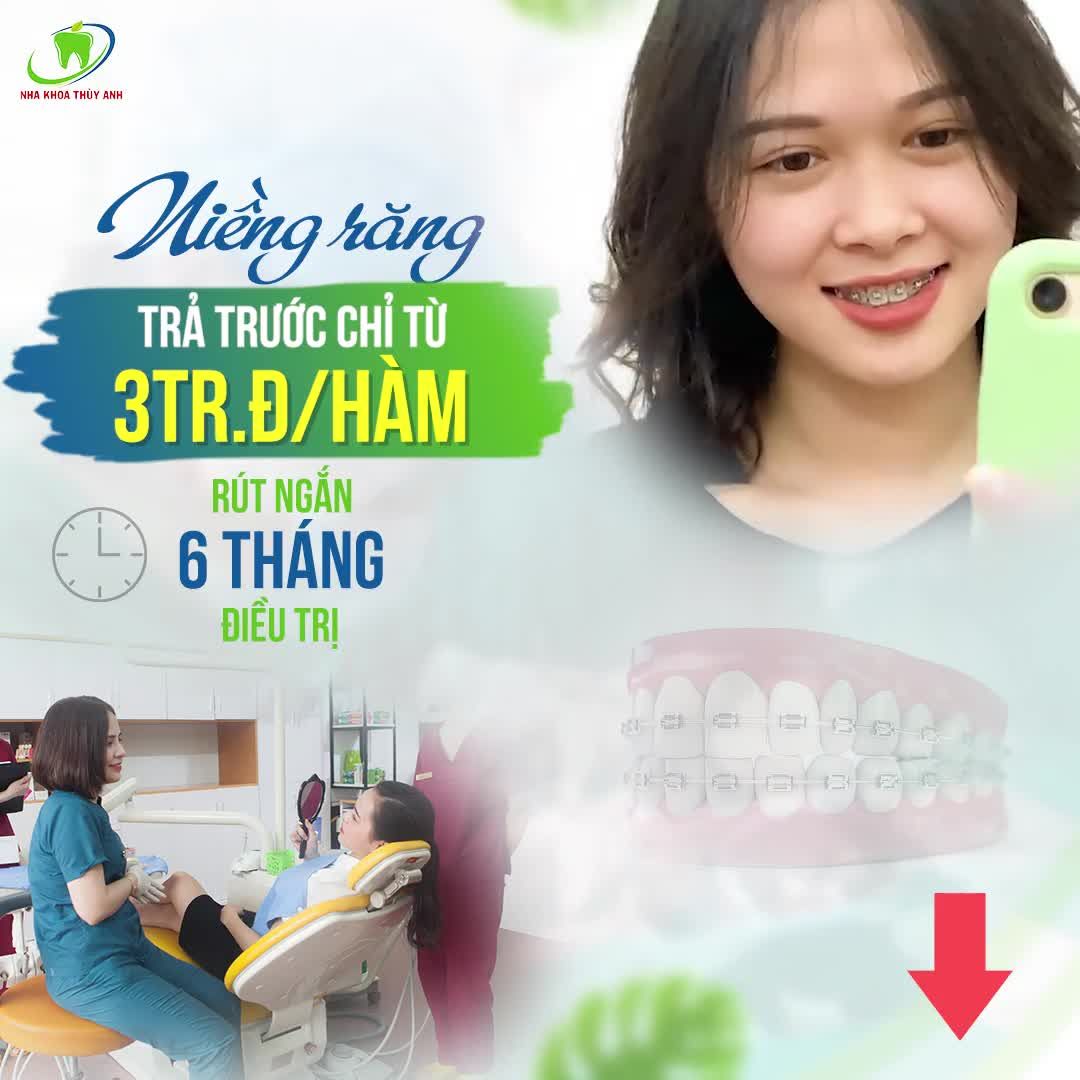NIỀNG RĂNG TRẢ TRƯỚC CHỈ TỪ 3TR.Đ/HÀM