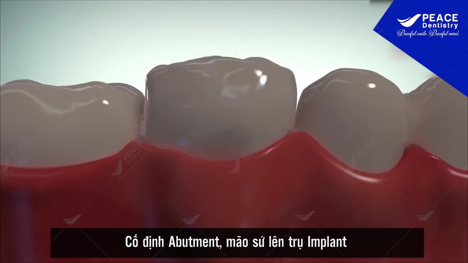 Trồng răng implant với bác sĩ chuyên gia tại Peace Dentistry