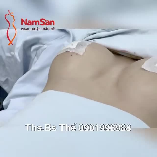 Vòng 1 lép, không có nhiều phần mềm nên đặt túi thể tích vừa phải nhằm tránh hiện tượng lộ túi, sờ thấy túi ở vùng đường viền xung quanh.