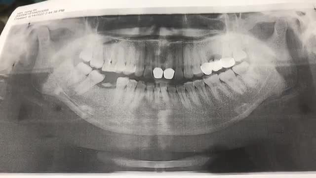 1 ca cấy implant R46