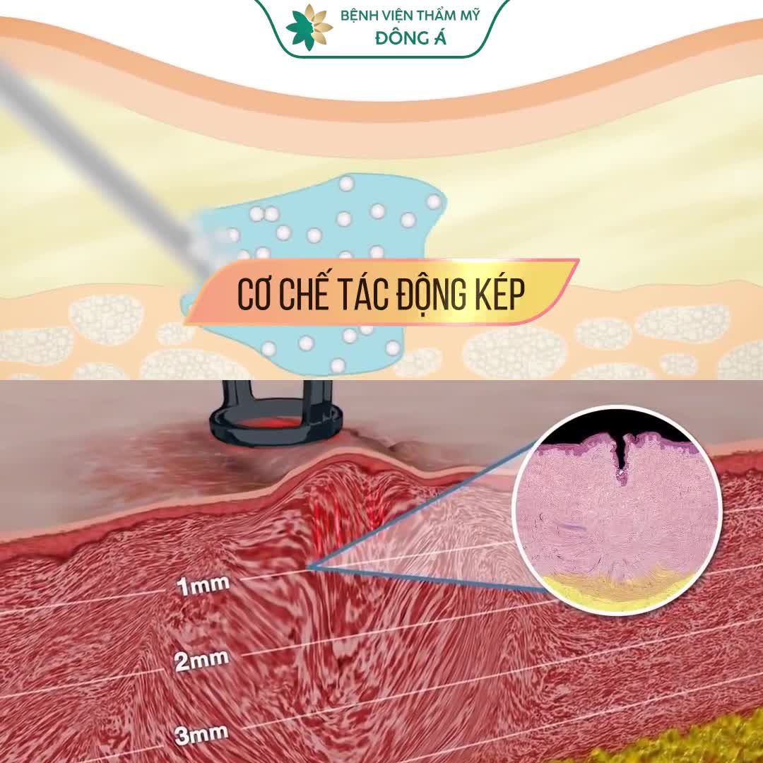 SẸO LỒI gây Ngứa? Mất thẩm mỹ? Khó chịu?