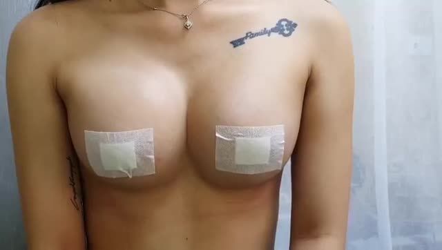 Tái khám :Nâng Ngực Nội Soi Chân Không