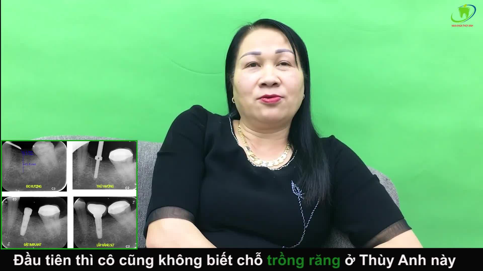 CHIA SẺ THỰC TẾ SAU KHI CẤY CHÂN RĂNG IMPLANT TẠI NHA KHOA THÙY ANH.