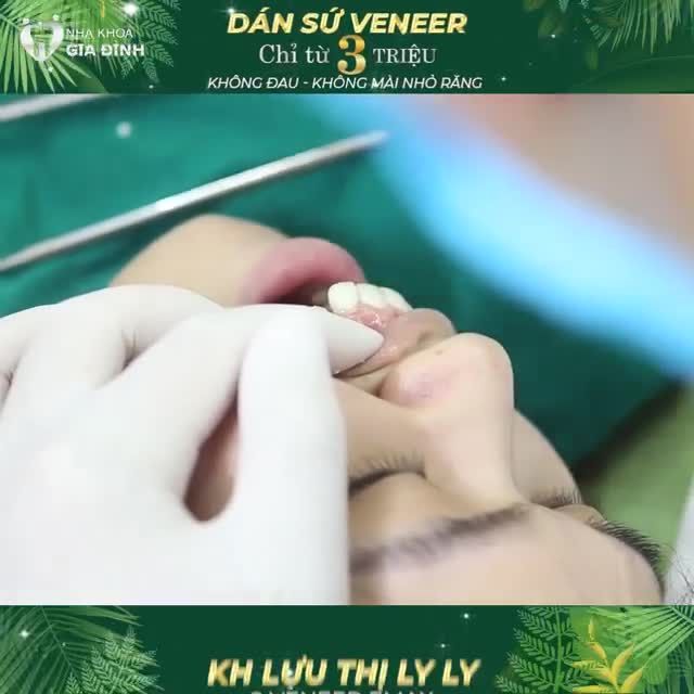 CHƯA KHÁCH HÀNG NÀO DÁN SỨ VENEER KHÔNG THÀNH CÔNG TẠI NHA KHOA GIA ĐÌNH