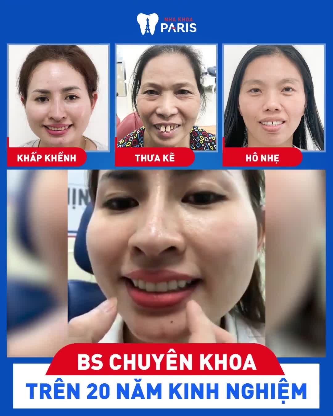 Hết Thưa/Hô/Khấp Khểnh với BỌC RĂNG SỨ NANO 5S