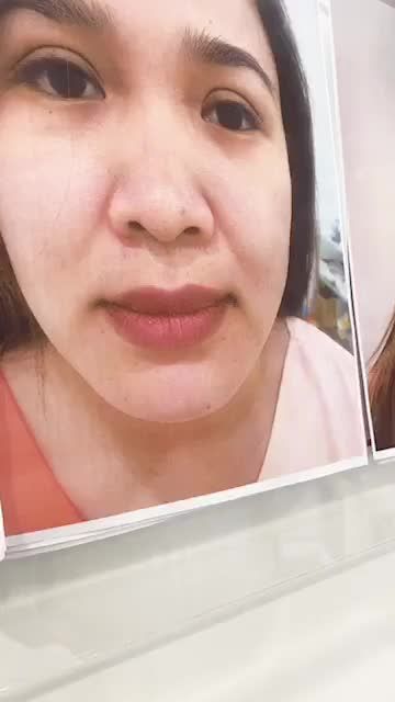 Nâng mũi cấu trúc sụn tai dáng Sline cao