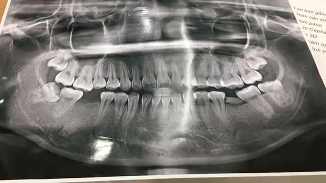 Cấy implant răng số 6 cho bạn Linh.