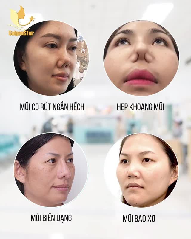 MŨI HỎNG NHIỀU LẦN PHƯƠNG PHÁP SỤN SƯỜN CÒN HIỆU QUẢ KHÔNG?