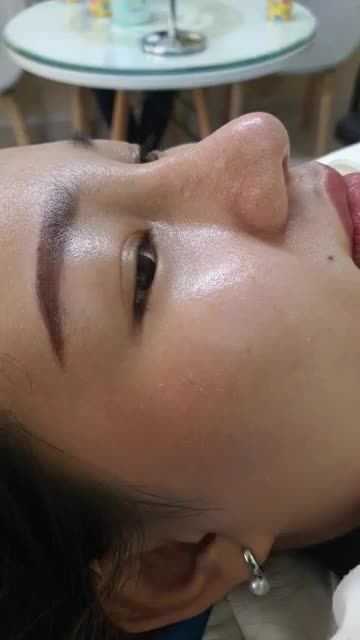 Nâng mũi sụn tai 2 lớp Sau 12 ngày Quá đẹp cho em gái Trà Vinh