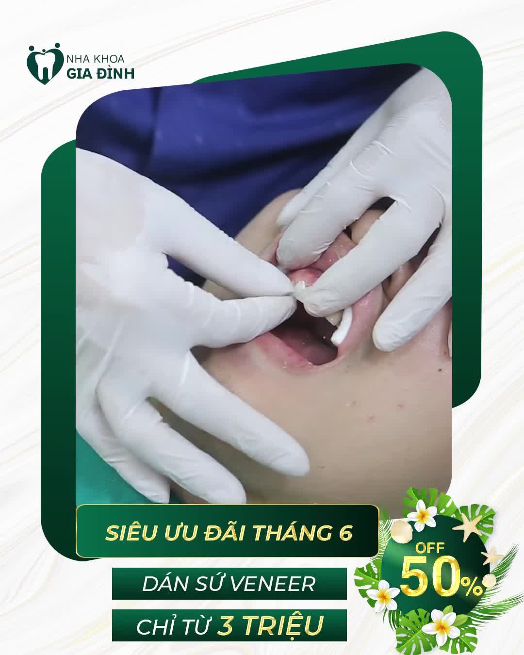 THẨM MỸ RĂNG SỨ ƯU ĐÃI ĐẾN 60% CHỈ 20 SUẤT CHO 20 KH ĐĂNG KÝ SỚM NHẤT!!!