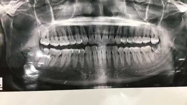 Nhổ răng khôn số 48 mọc kẹt, sâu vỡ lớn thân răng cho anh Quang.