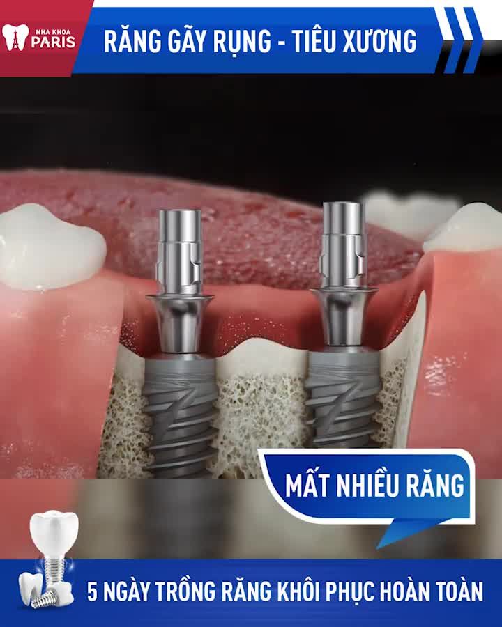 NHẬN ƯU ĐÃI CẮM IMPLANT CHỈ OFF 30%