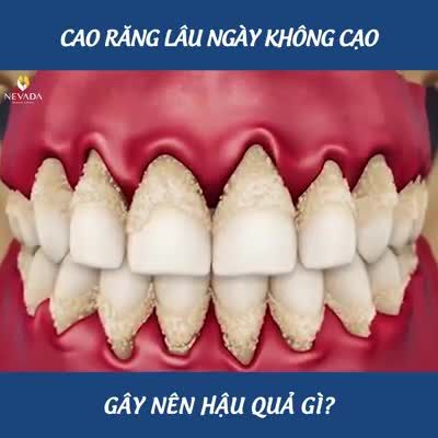 ĐÃ BAO LÂU RỒI BẠN CHƯA LẤY CAO RĂNG?