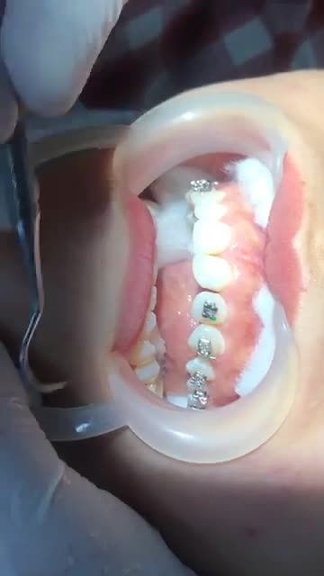 GẮN MẮC CÀI điều trị răng KHẤP KHỂNH HÀM TRÊN tại Nha Khoa Vân Anh !!!