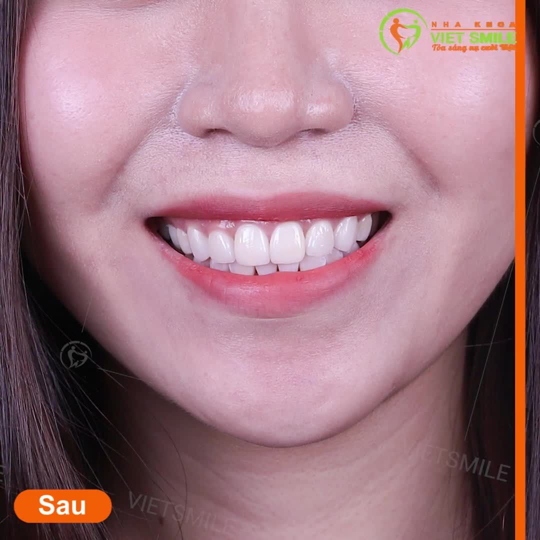 GIẢI PHÁP NÀO CHO HÀM RĂNG ĐÃ PHỦ SỨ NANO