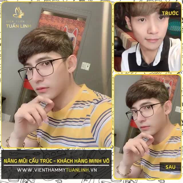 "HOÁN ĐỔI " dáng mũi cao tây cho nam chỉ với NÂNG MŨI CẤU TRÚC