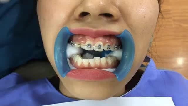Quy trình gắn mắc cài chỉnh nha tại Nha Khoa Thuỳ Anh.