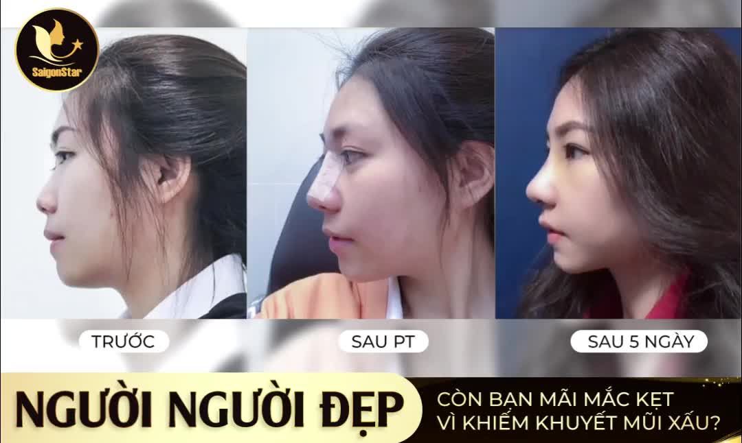 NGƯỜI NGƯỜI ĐẸP CÒN BẠN MÃI MẮC KẸT - VÌ KHIẾM KHUYẾT MŨI XẤU?