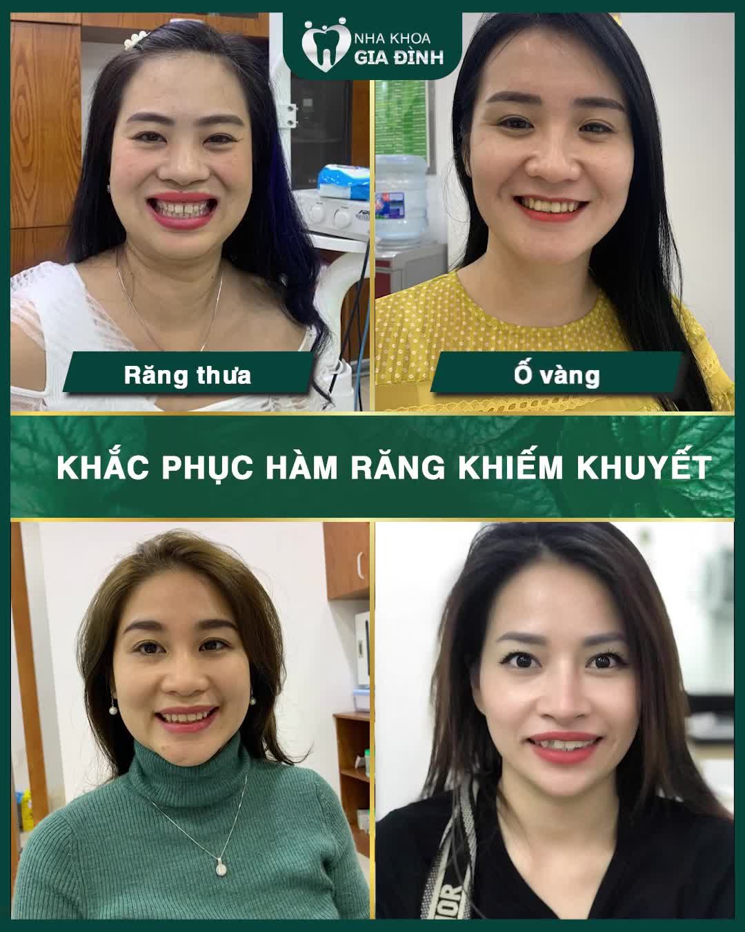 THẨM MỸ RĂNG TẠI NHA KHOA GIA ĐÌNH AN TOÀN – TRẮNG ĐẸP – BỀN CHẮC DÀI LÂU