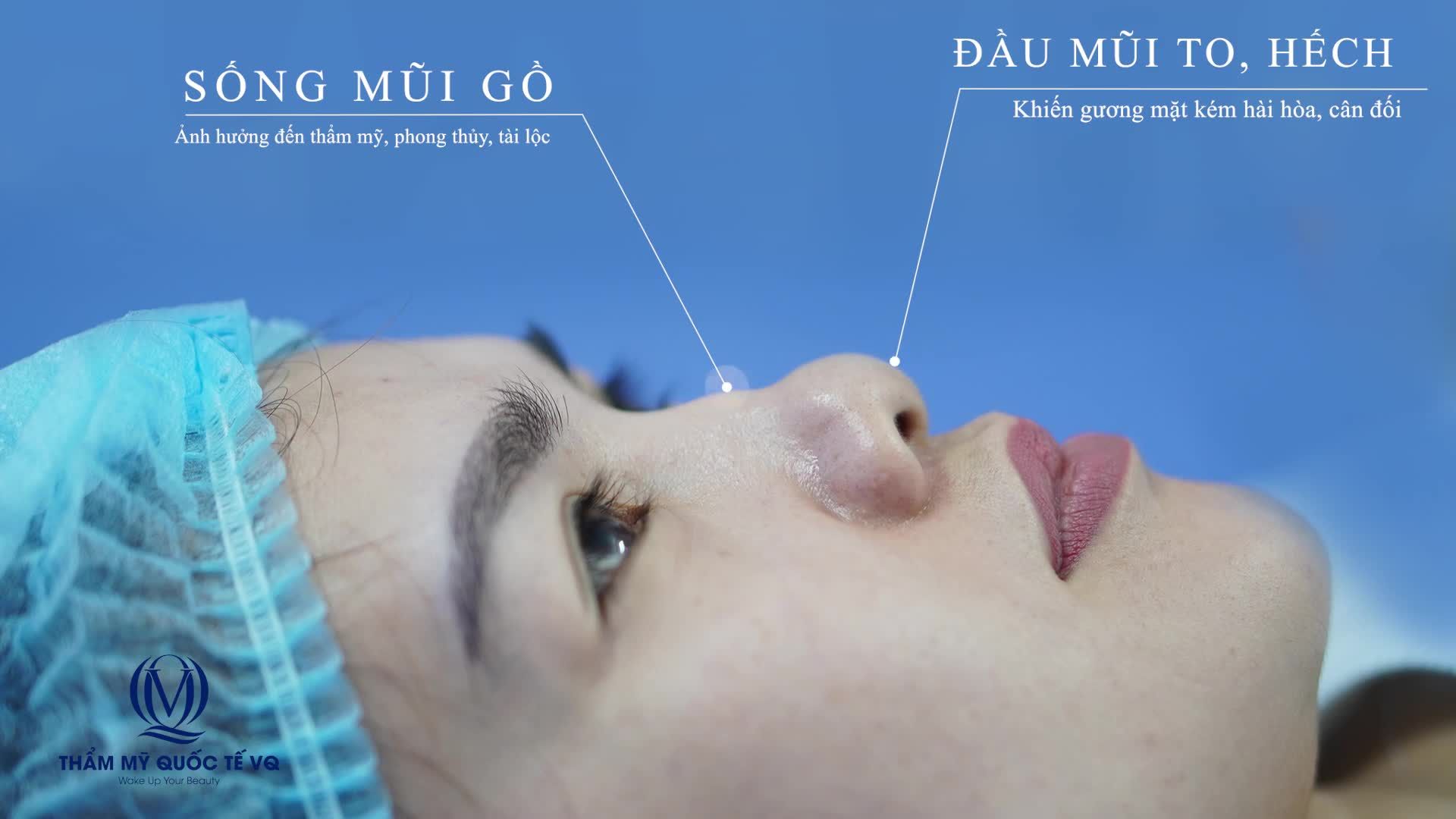 "HOÁN ĐỔI " dáng mũi cao sang mềm mại cho bạn khách hàng chỉ với NÂNG MŨI SOFTLINE