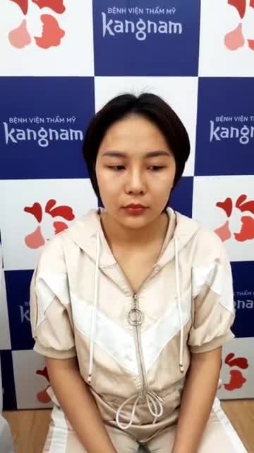 KH nâng mũi sline 4D + cắt cánh mũi sau 10 ngày cắt chỉ