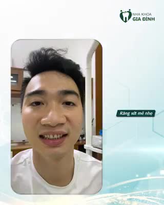 NHỮNG TRƯỜNG HỢP NÊN DÁN SỨ VENEER