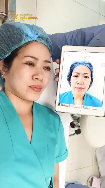 LOẠI BỎ HOÀN TOÀN BỌNG MỠ MẮT, TRẺ HÓA MẮT TỚI CẢ CHỤC TUỔI NHỜ CẮT MÍ DƯỚI TẠI TMV XUÂN HƯƠNG