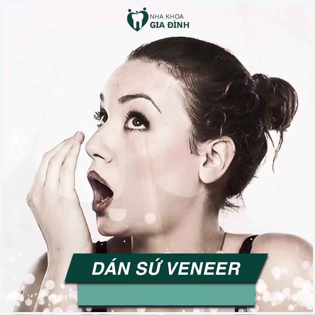 3 LẦM TƯỞNG VỀ DÁN SỨ VENEER