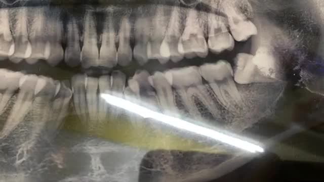 Nhổ răng khôn mọc lệch 90 độ, gây dắt thức ăn cho bạn Mai tại Nha Khoa Thuỳ Anh.