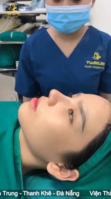 Case Nâng mũi cấu trúc Surgiform