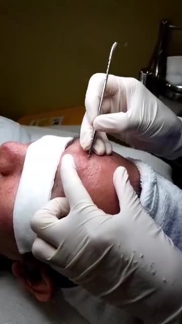 Cùng Kangnam loại trừ mầm mống mụn với Nanoskin