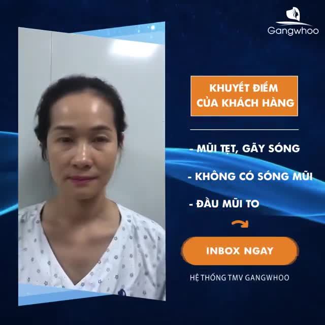 CÙNG TÌM HIỂU VỀ SỤN SURGIFORM VÀ THEO DÕI CẬN CẢNH QUI TRÌNH NÂNG MŨI CỦA LOẠI SỤN ĐẶC BIỆT NÀY NHÉ‼
