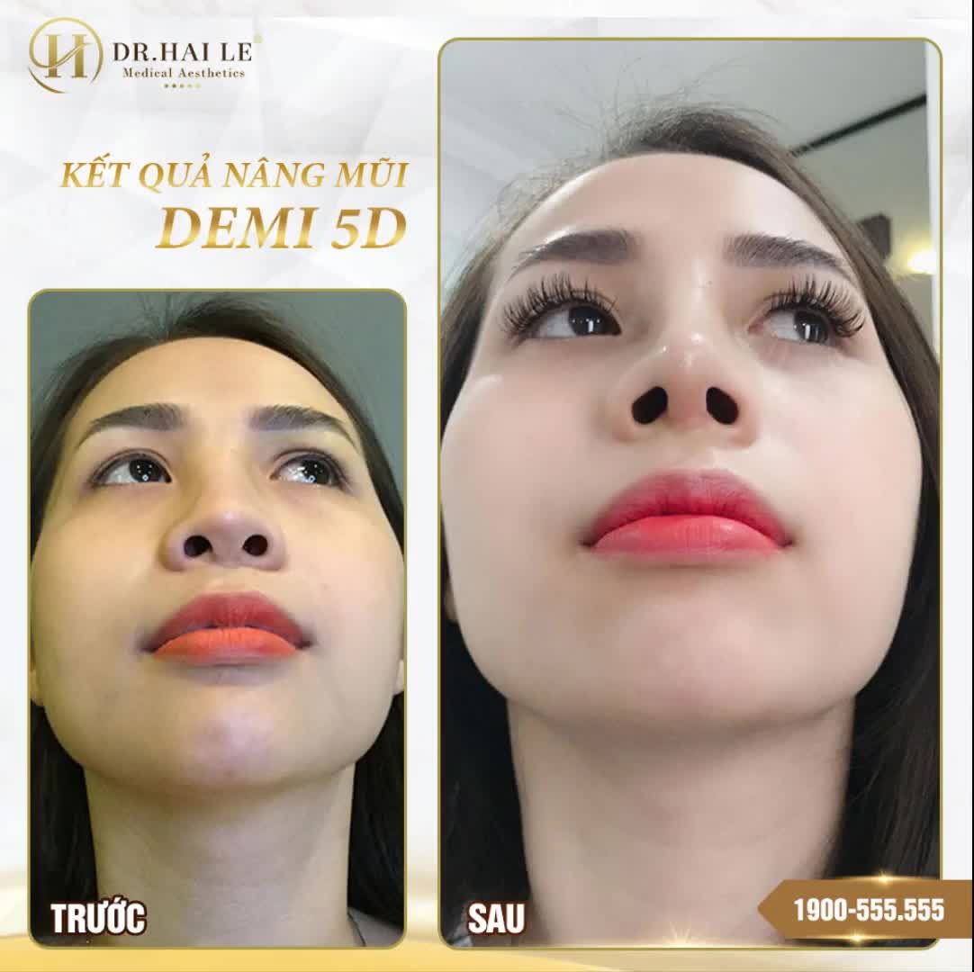 ĐẸP ĐẾN NGỠ NGÀNG VỚI NÂNG MŨI DEMI 5D‼️