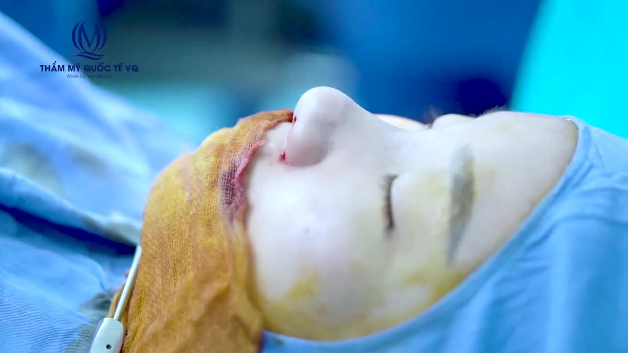 DR VŨ QUANG - BẬC THẦY NÂNG MŨI!