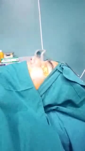 KẾT QUẢ CA NÂNG MŨI SỤN SƯỜN CHO KHÁCH HÀNG SỬA MŨI HỎNG 3 LẦN - XỬ LÝ TRỤ MŨI 11 LẦN