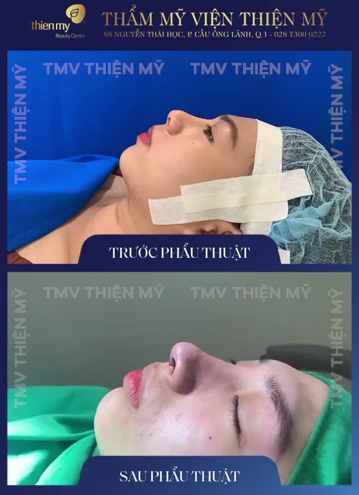 NÂNG MŨI NÊN HAY KHÔNG NÊN