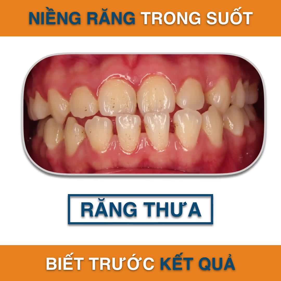 TRÊN 30 TUỔI MUỐN NIỀNG RĂNG THÌ NÊN CHỌN PHƯƠNG PHÁP NÀO?