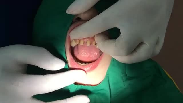 Gắn răng sứ cho khách hàng tại Nha Khoa Thuỳ Anh.