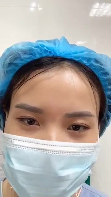 Thực hiện xong treo cung mày của bác sĩ ưng quá nên đăng kí thêm dịch vụ cắt mí dưới