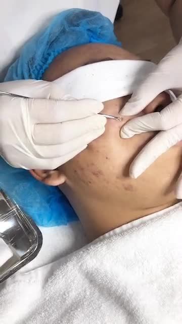 MỤN khiến bạn mất tự tin, phải làm sao đây