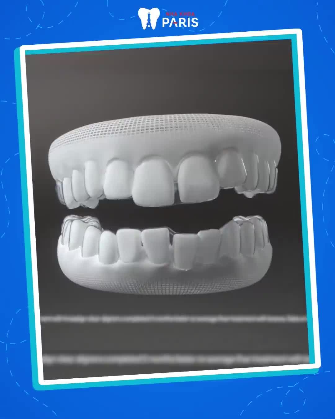 NIỀNG RĂNG TRONG SUỐT BAO LÂU THÌ ĐẸP?