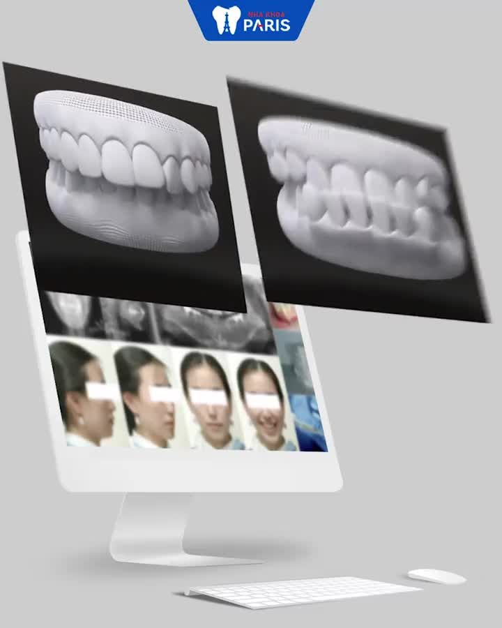 Trên 80% case NIỀNG RĂNG rút ngắn 6 tháng tại Nha khoa Paris