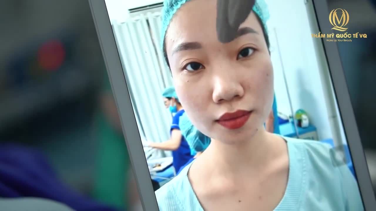 Bác sĩ Vũ Quang điêu khắc, đặt sụn nâng mũi khắc phục Gốc mũi thấp, Sống mũi gồ, Đầu mũi to ( Phút 1: 16) .