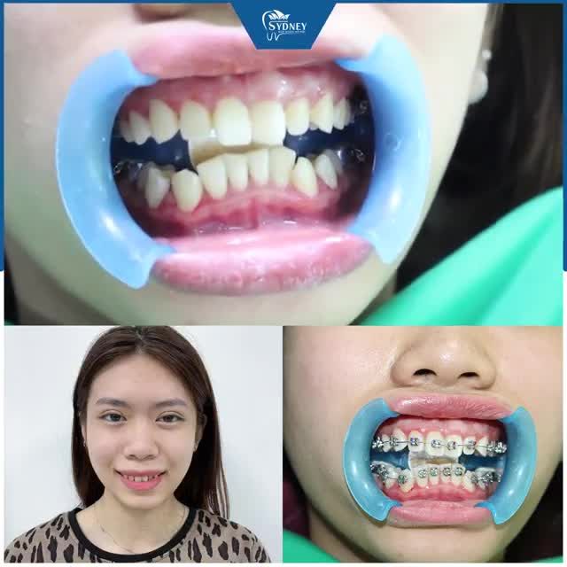 CẢNH BÁO: "ĐỪNG ĐỢI QUÁ MUỘN MỚI ĐI NIỀNG RĂNG"